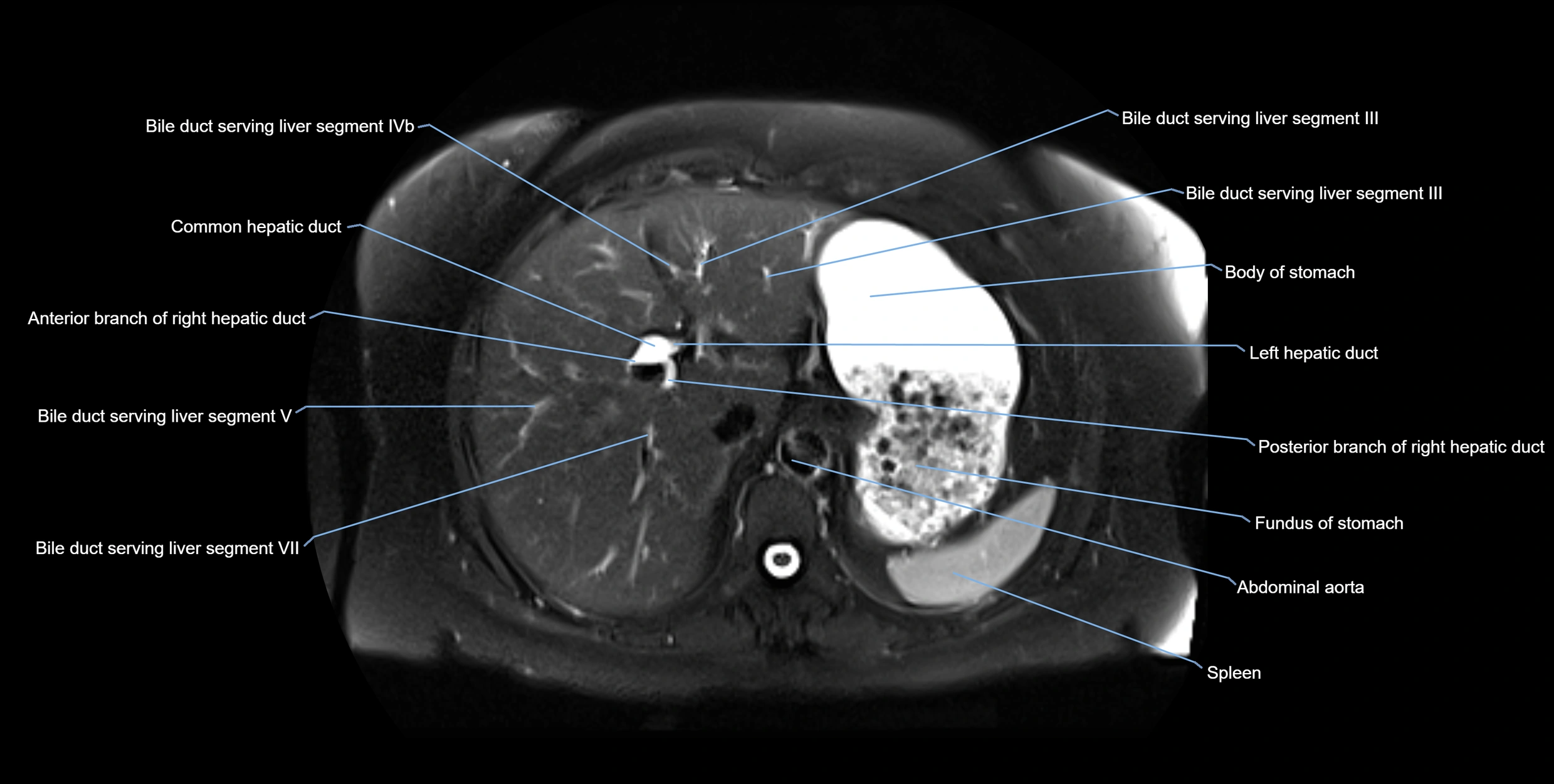 MRI MRCP axial cross sectional anatomy 3T radiology  image-img-10001-00014.webp